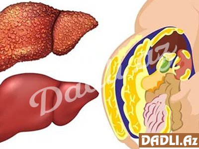 Hər evdə olan bu adi 3 məhsul qaraciyəri xəstəliklərdən qoruyur